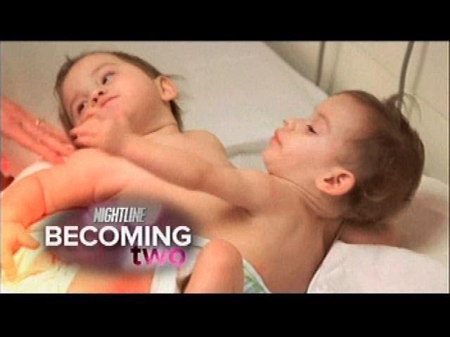 Conjoined Twins, Erika & Eva Sandoval Successfully Separated