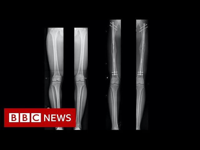 Leg-lengthening: The people having surgery to be a bit taller - BBC News