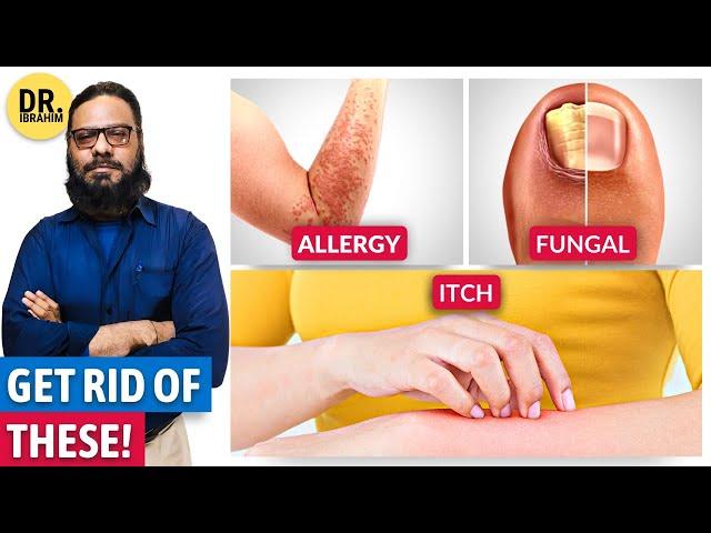 Get Rid of Itchy Skin, Skin Allergy & Fungal Infection! (Urdu/Hindi) Kharish | Dr. Ibrahim