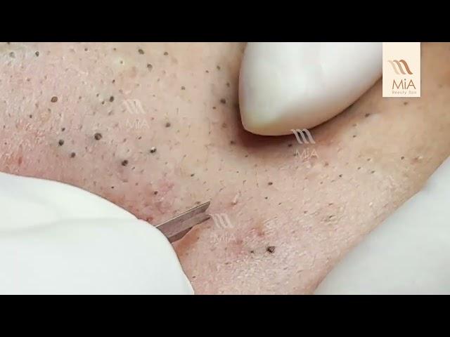 SUPER BLACKHEADS at MiA Beauty Spa