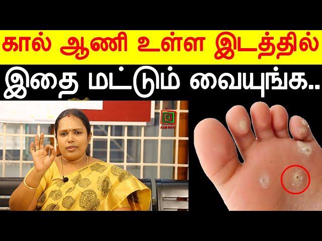 கால் ஆணியை குணப்படுத்த சில எளிய இயற்கை வைத்திய முறைகள்! Dr.Rajalakshmi | ASM INFO