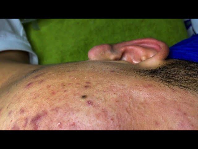 The best acne squeezing collection form Linh Mun Spa part 19