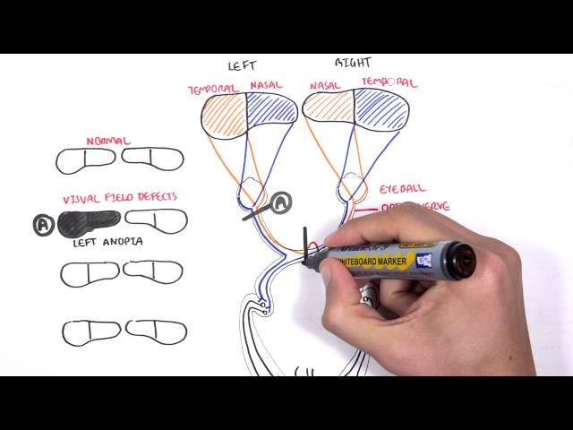 Visual Pathway and Lesions