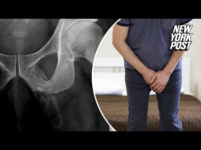 X-rays reveal ‘calcified’ penis that doctors say is turning to bone