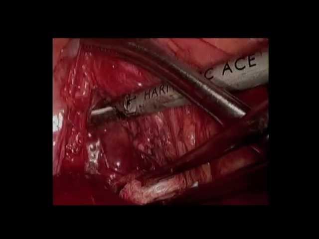 Thoracoscopic Resection of Giant Mediastinal Parathyroid Tumor