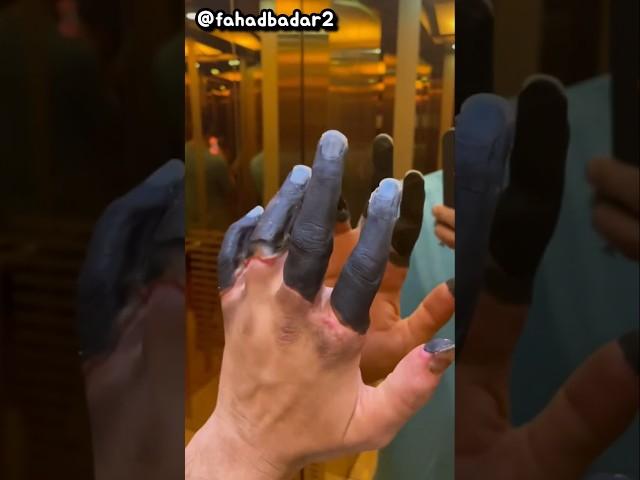 이렇게 손가락 동상이 걸리면 대처하는 방법