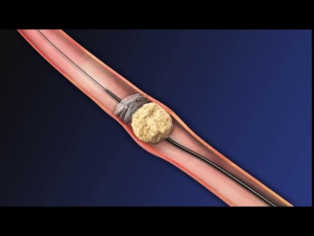 CoAx 10mm Stone Control Catheter from Accordion Medical