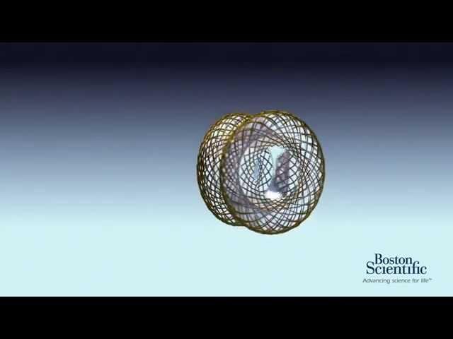 AXIOS™ Stent and Delivery System Animation