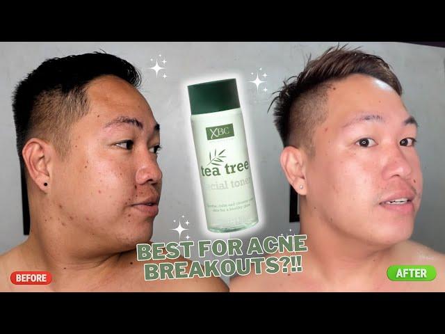 TONER FOR ACNE BREAKOUTS?! 100 PESOS  LANG AND EFFECTIVE!! ( XBC Tea Tree Facial Toner)