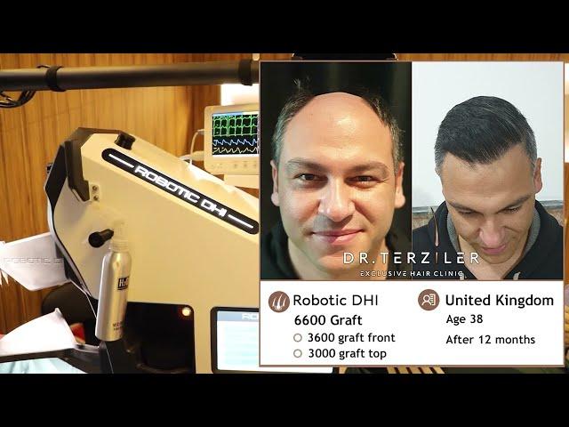 Robotic DHI Hair Transplant and Before - After Photos