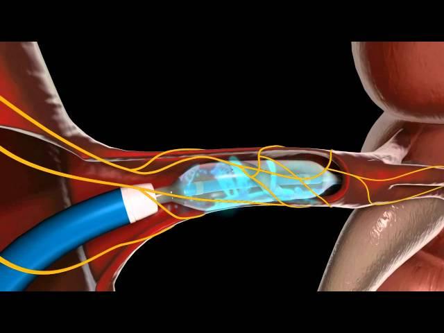 3d Medical animations MVR Covidien