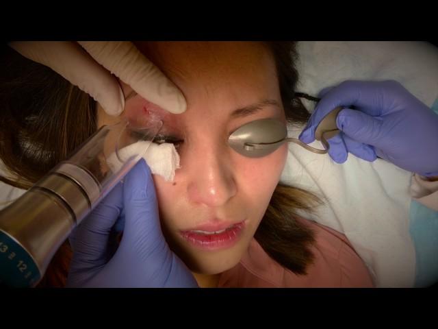 Permanent Makeup Removal