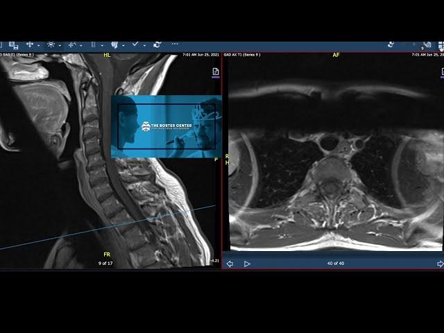 Multiple Sclerosis MRI: MS Lesions on Spine