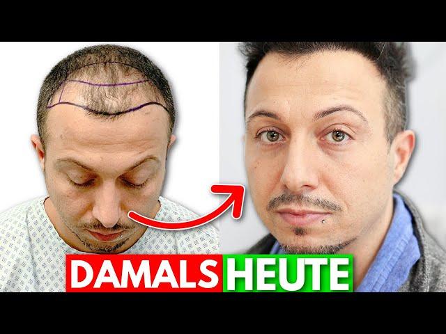 Nur 7 Monate nach der Haartransplantation in Deutschland | Erfahrung