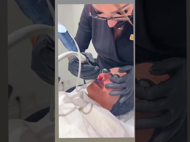 ReDerma Fractional CO2 Laser | How to Remove wrinkles & scars without surgery