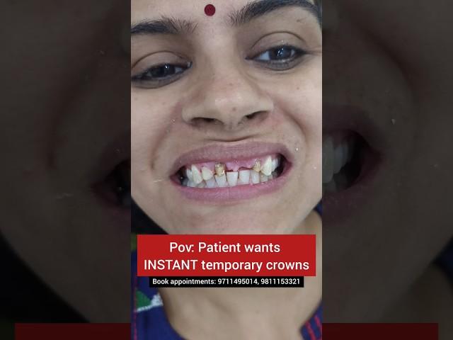 INSTANT temporary tooth caps in 15 minutes! Dr. Srishti Bhatia #smiletransformation