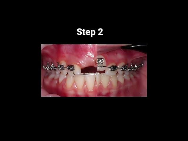 How do braces work?