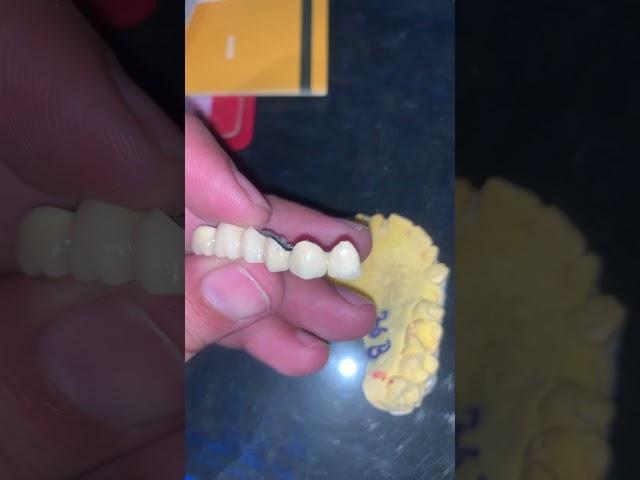 Porcelain metal bridge #dentist #umairtoothfairy #satisfying #umairazeem ​⁠@umairazeem8553