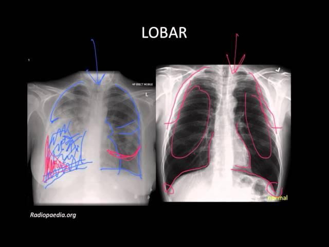 Pneumonia: Imaging