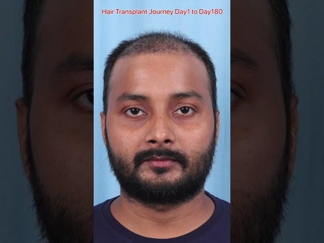 Hair Transplant Results Day 1 to Day 180 #shorts #hairtransplant 7426859490 WhatsApp