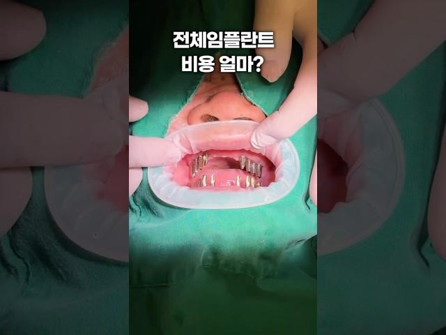전체임플란트 가격 #dental #dentist #implantdentist #dentalclinic