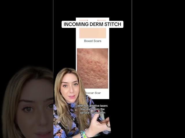 Treating Acne Scars Part 2 #shorts