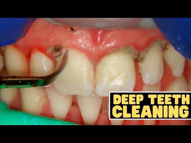 Teeth Cleaning vs Deep Cleaning | Dentist Reviews How Teeth Are Cleaned!