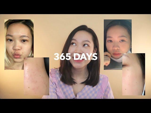 Why I Wear Sunscreen Everyday For 365 Days (Before/After Pictures) | Euodias