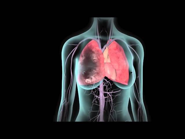 What Are the Symptoms of a Blood Clot in Your Lung?