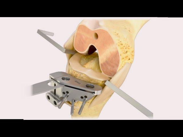 Step-by-Step Approach to Total Knee Replacement