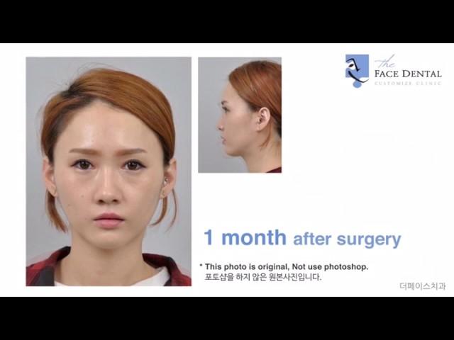 더페이스치과 양악수술(Double jaw surgery Before & After)