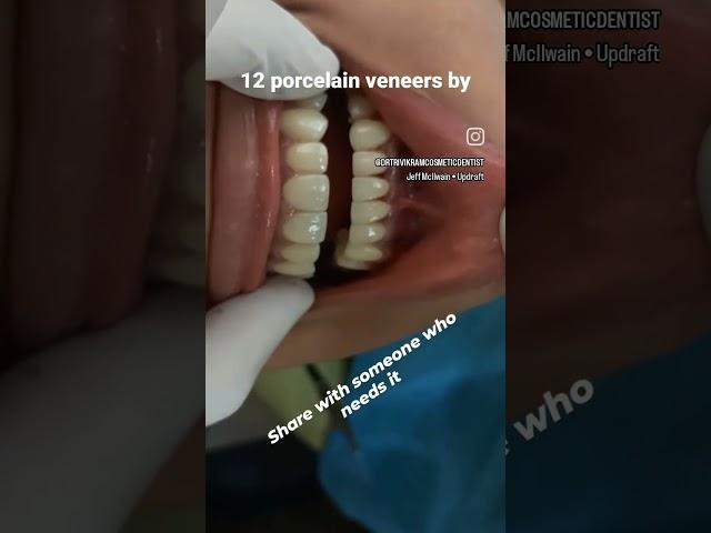 Smile makeover/ Cosmetic dentistry by Dr Trivikram Bangalore.
