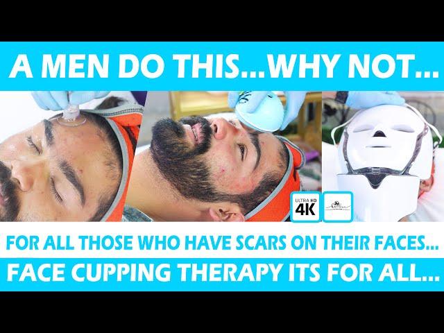 A MEN DO THIS…WHY NOT…FACE CUPPING THERAPY FOR ALL@halinathecuppingclinic