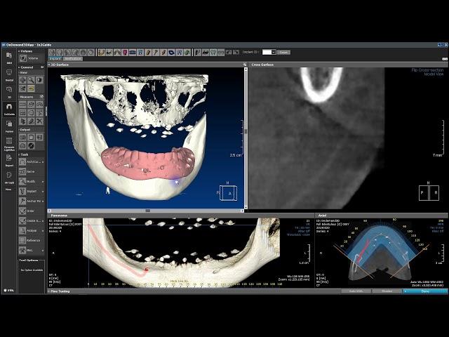 Full Edentulous I A Nerve Generation