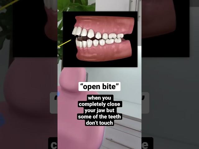 do you have an open bite? #shorts