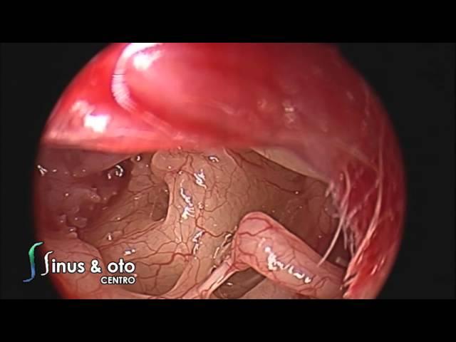 Low Flow Perilymphatic Fistula