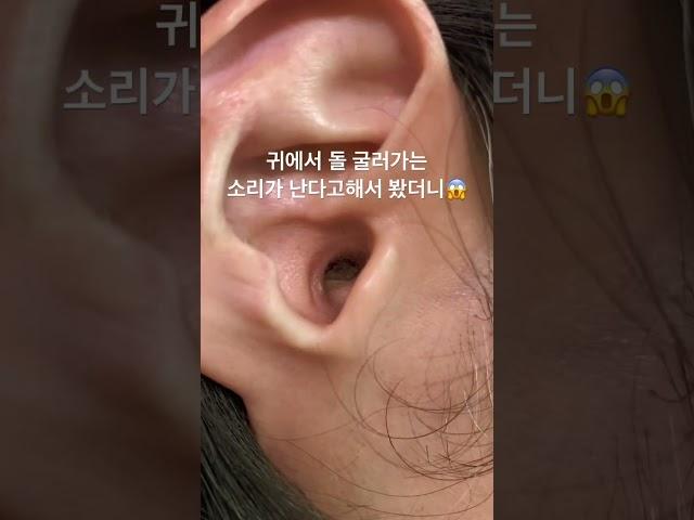 고막을 덮은 마른 귀지?!! #귀지 #귀지제거 #마른귀지 #귀파기 #귓밥 #耳掃除 #earwax #귀청소 #왕귀지 #earcleaning