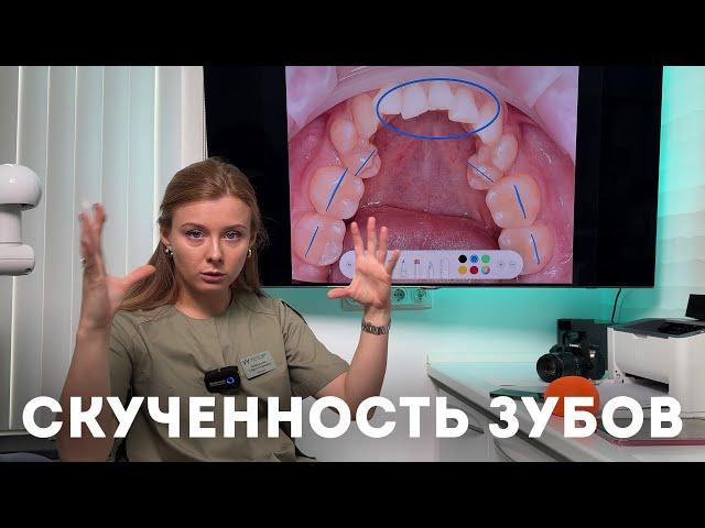 Скученность зубов — что делать, когда зубам нет места в зубном ряду?