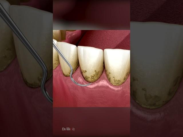 AMSR Tarter Removal: Dental Cleaning to Remove Plaque & Tarter Buildup