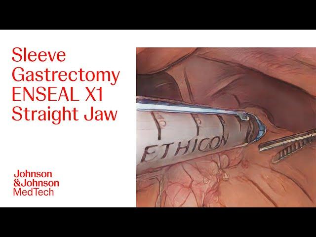 Performing a Sleeve Gastrectomy with ENSEAL X1 Straight Jaw | J&J MedTech