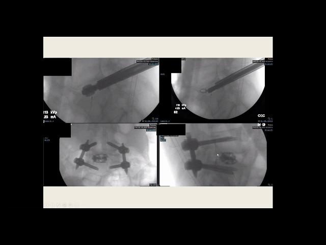 Awake Endoscopic Spinal Fusion Explained by Dr. Albert Telfeian - How I Do It Series