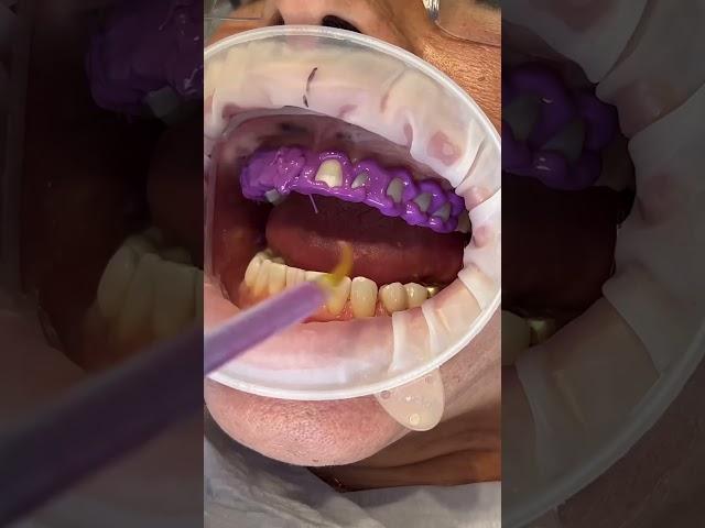 Biomimetic Esthetic Dentistry - Veneers PART I #biomimeticdentistry #veneers #estheticdentistry