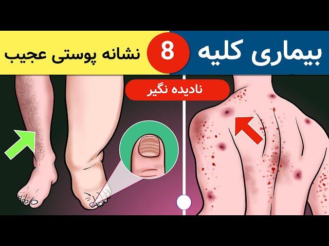 هشت نشانه ی هشدار دهنده ی بیماری کلیه | علائم پوستی بیماری کلیوی