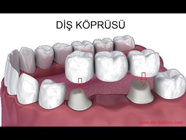 Dental Bridge Procedure