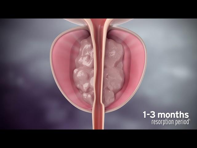 Rezūm Water Vapor Therapy Procedure Animation for Physicians