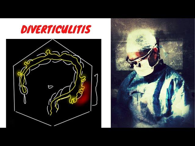 DIVERTICULITIS EXPLAINED