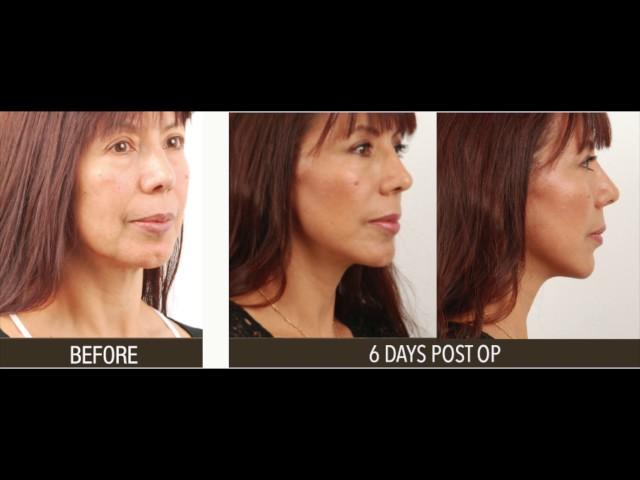 Face Lift Surgery