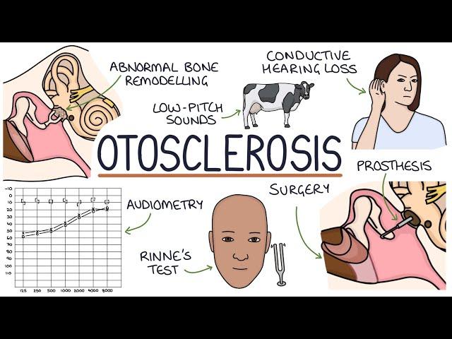 Understanding Otosclerosis