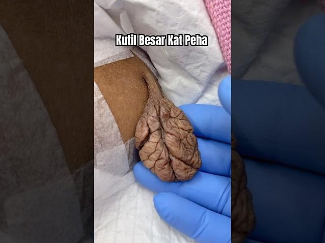 Laser Kutil SkinTag Besar Tumbuh Kat Peha Makin Membesar - DrMan Ttdi Story