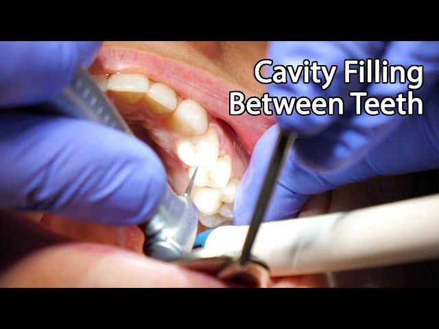 Dentist Filling A Cavity Between Teeth